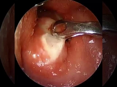 বর্তমান ≤1.5mA আর্থ্রোস্কোপি আরএফ প্লাজমা ওয়াড সার্জিক্যাল সরঞ্জাম কাঁধ হিপ হাঁটু