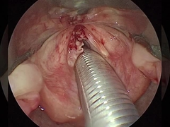 বর্তমান ≤1.5mA আর্থ্রোস্কোপি আরএফ প্লাজমা ওয়াড সার্জিক্যাল সরঞ্জাম কাঁধ হিপ হাঁটু